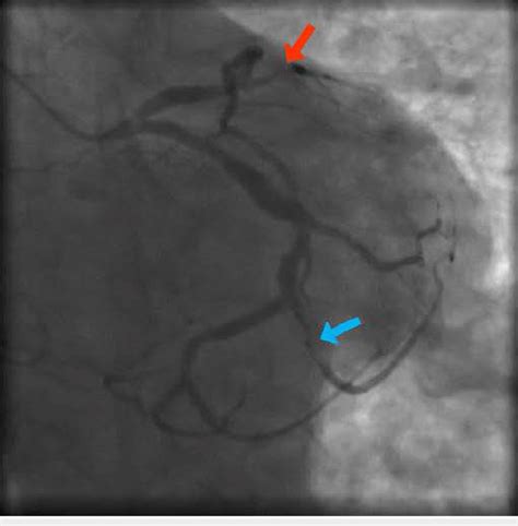 Multiple Lad Lesions And Severe Lesions Of The Om2 Branch Lad Is