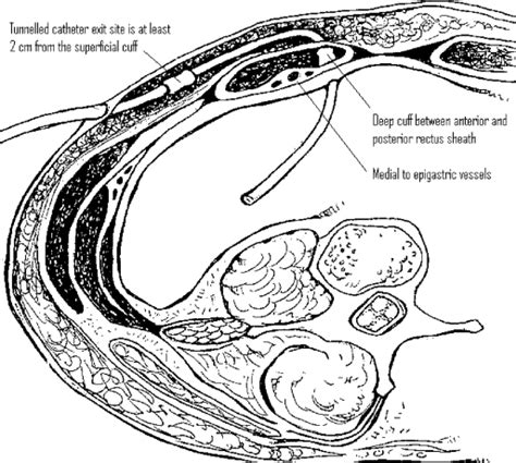 Cross section showing optimal catheter placement through abdominal wall ...