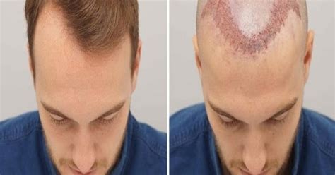 5 Tips For Hair Transplant Recovery