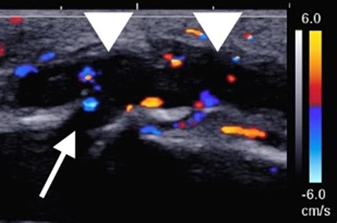 Sagittal B Mode And Color Doppler Ultrasound Images Show Thrombosed