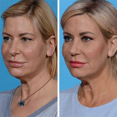 Rhinoplasty Dr Jeffrey Lisiecki