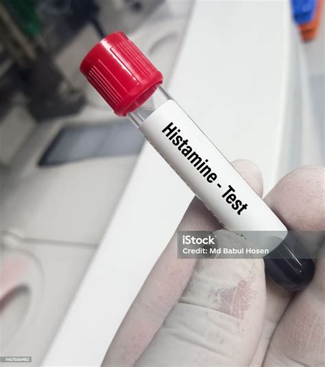 Blood Sample For Histamine Blood Test To Diagnosis Of Anaphylaxis