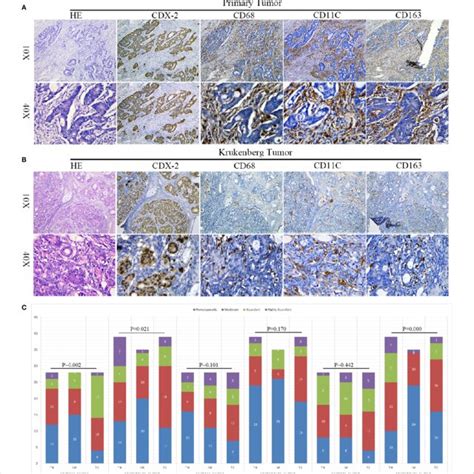 Grade Scoring Of Cd68 Tams In Tumor Stroma Of Primary Tumors A Download Scientific Diagram