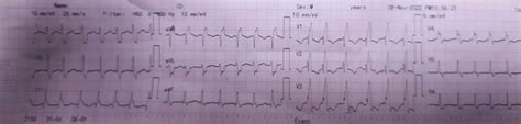 Type of arrhythmia : r/ECG