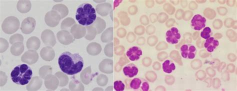 Mature Lymphoid Neoplasms Flashcards Quizlet