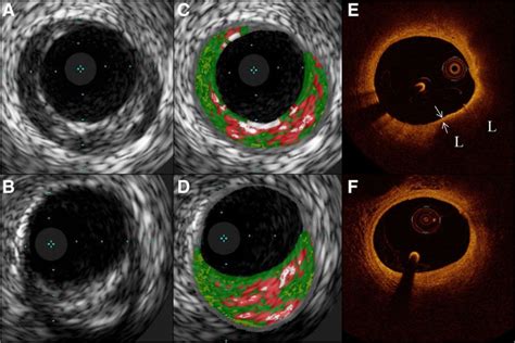 Clinical Implications Of Intracoronary Imaging In Cardiac Allograft