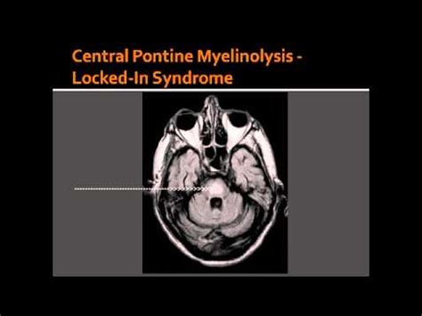 Central Pontine Myelinolysis Locked In Syndrome Youtube