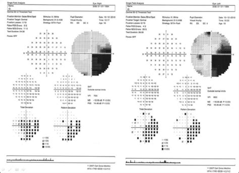 Homonymous quadrantanopia at peripheral visual field ex | Open-i