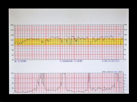 Fetal Monitor Patterns