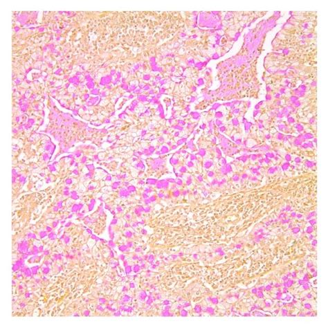 Immunohistochemistry Showing Staining With Mucicarmine A Ck And