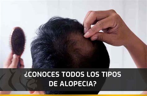 Conoces Todos Los Tipos De Alopecia Capilar Center