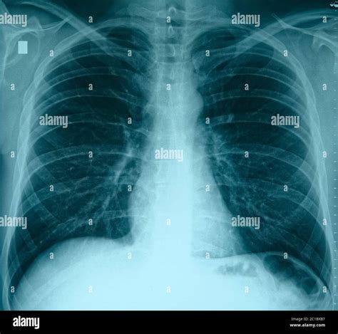 Pulmones Sanos Radiografía Tórax Fotografías E Imágenes De Alta