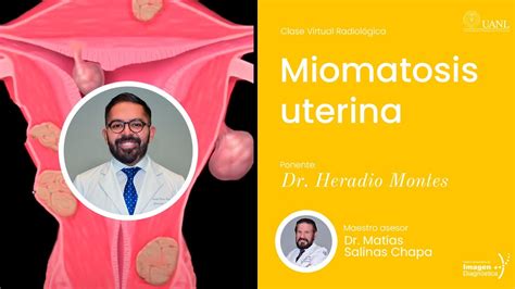 Miomatosis Uterina Por El Dr Heradio Montes Rodr Guez Youtube