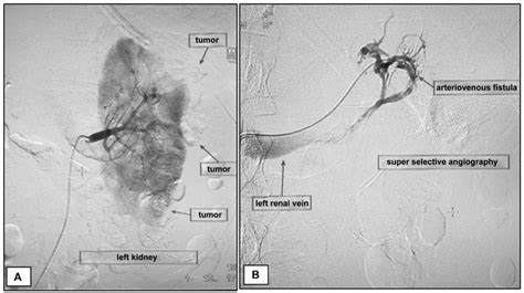 SciELO Brasil Embolization Of Ruptured Renal Angiomyolipoma In