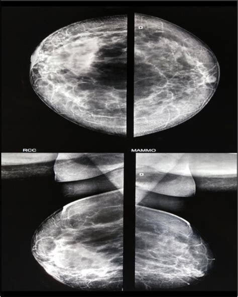 Figure From Bilateral Idiopathic Granulomatous Mastitis A Rare Benign