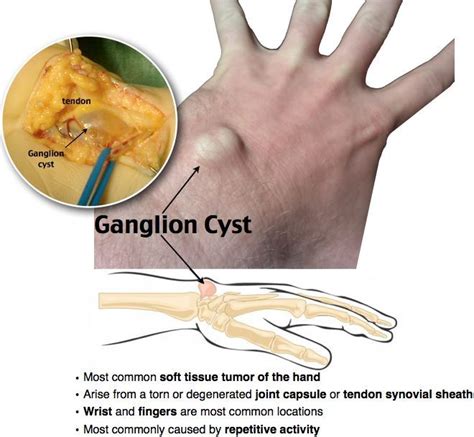 Top Pictures Pictures Of Ganglion Cysts On Wrists Superb