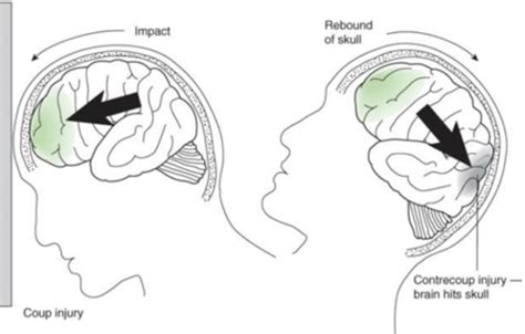 Week 9 Traumatic Brain Injury Flashcards Quizlet