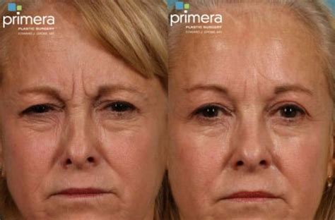 Blepharoplasty Before And After Pictures Case 66 Orlando And Tampa