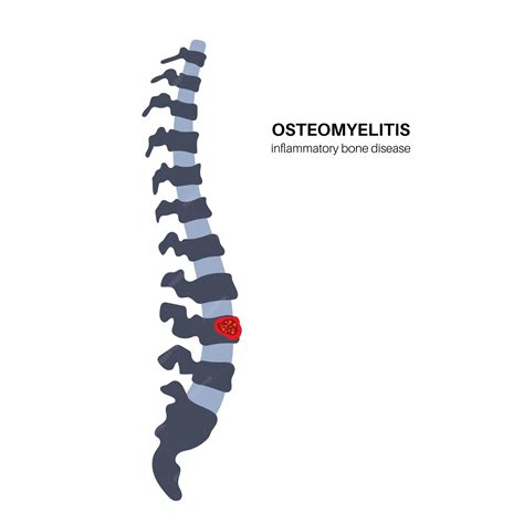 Osteomielite Vertebral Infectado Sequestro De Ossos Da Coluna Vertebral