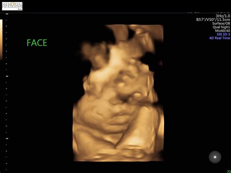 Our 3D Ultrasound Carmelita Middleton