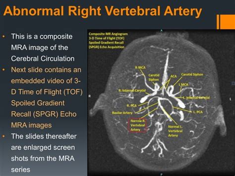 Abnormal Right Vertebral Artery Mra Sequence Sanjoy Sanyal