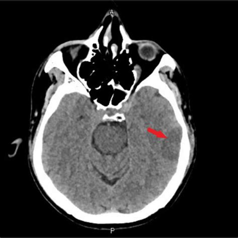 Ct Head Showing Hypodense Lesion In Left Temporal Lobe Arrow Possible Download Scientific