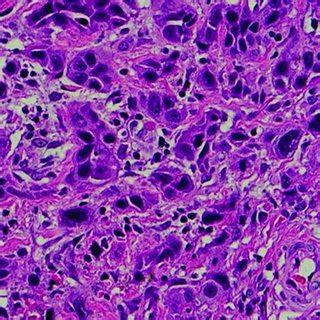 Photomicrographs Showing Extranodal Diffuse Large B Cell Lymphoma