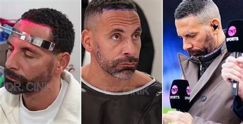 Rio Ferdinand Reveals He S Had A Hair And Beard Transplant In Turkey