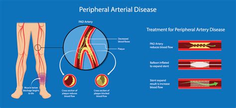 Peripheral Arterial Disease Treatment El Paso I I Specialists