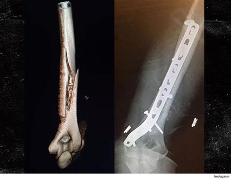 Lindsey Vonn Crashes Hard In Ski Practice Cracks Arm Bone