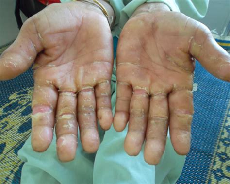 Bizarre Skin Disease Outbreaks Again In Quang Ngai