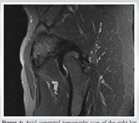 Figure 4 From Heterotopic Ossification Secondary To Motor Vehicle