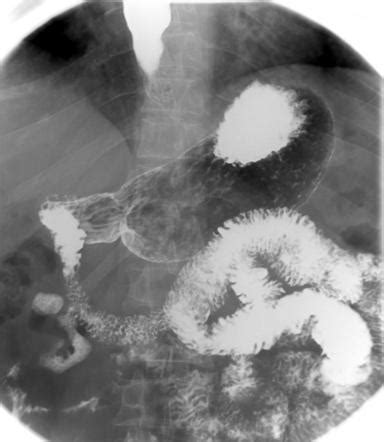 Achalasia Image Radiopaedia Org