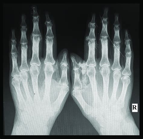 X-ray of hands with erosive arthritis and periarticular calcification ...