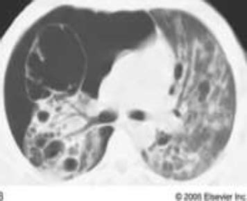 Pleural Disease Flashcards Quizlet