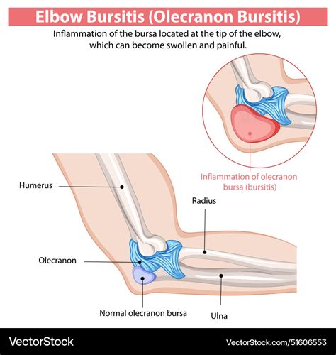 Inflammation Of The Elbow Bursa Causing Pain Vector Image