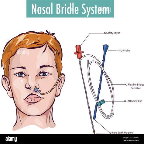 Nasogastric Tube Hi Res Stock Photography And Images Alamy