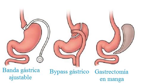 Alcalde José Luis Fábrega ¿qué Es Cirugía Bariátrica