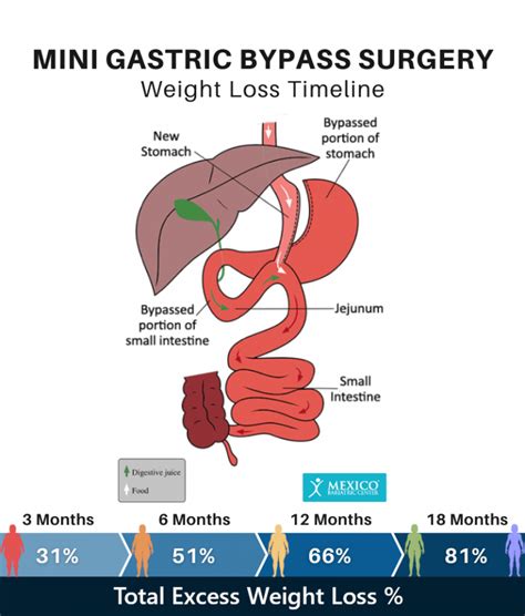 Bariatric Surgery Weight Loss Calculator