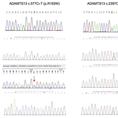 Sanger Sequencing Results In Adamts13 Of Our Patient His Older