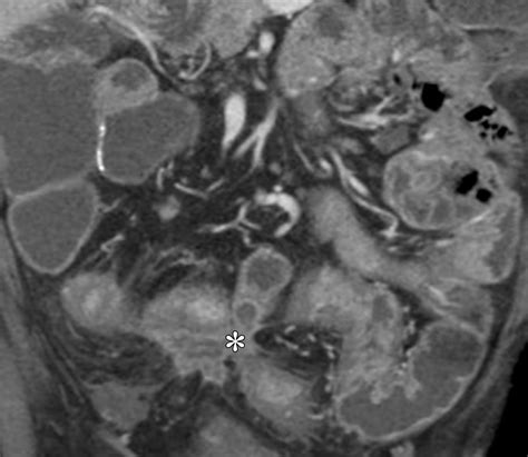 Ct Findings Of Acute Small Bowel Entities Radiographics