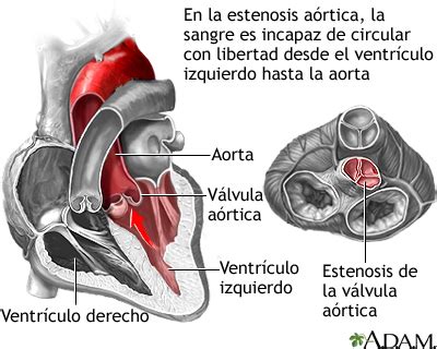 Estenosis A Rtica Medlineplus Enciclopedia M Dica