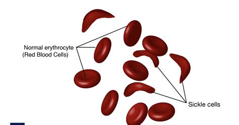 Sickle Cell Anemia Causes Symptoms Clinical Trials And Treatment Basis Intelligent Medicine