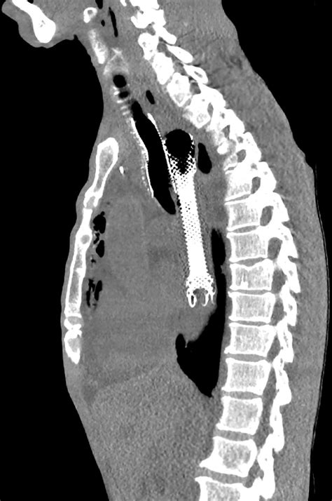 Tracheal Stents Clinical Tree