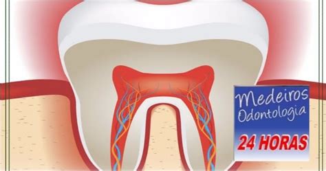 Medeiros Odontologia Horas O Que Pulpite Causas Diagn Stico