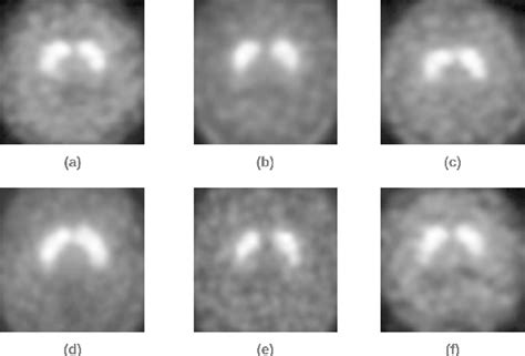 Figure From An Ensemble Of Cnn Models For Parkinsons Disease