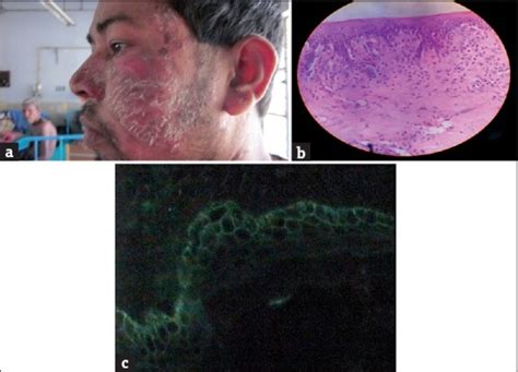 A Clinicopathological Study Of Pemphigus In Eastern India With Special