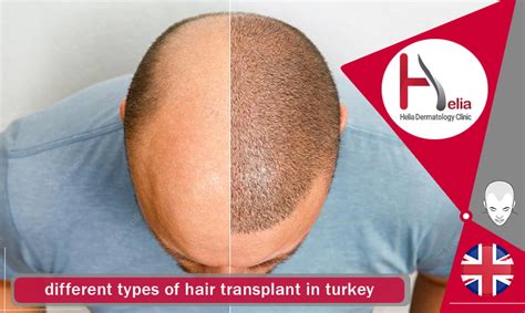 Hair Transplant In Turkey Highest Density Cost 2024 Helia Clinic