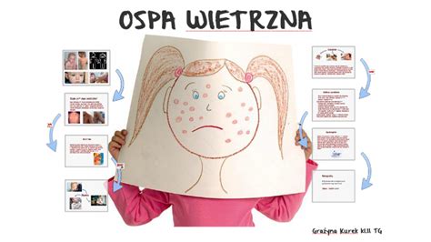 Ospa Wietrzna By Gra Yna Kurek On Prezi