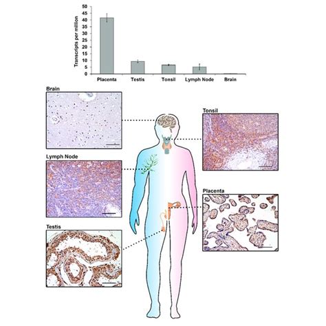 IGF2BP3 MRNA Top And Protein Bottom Expression Detected By